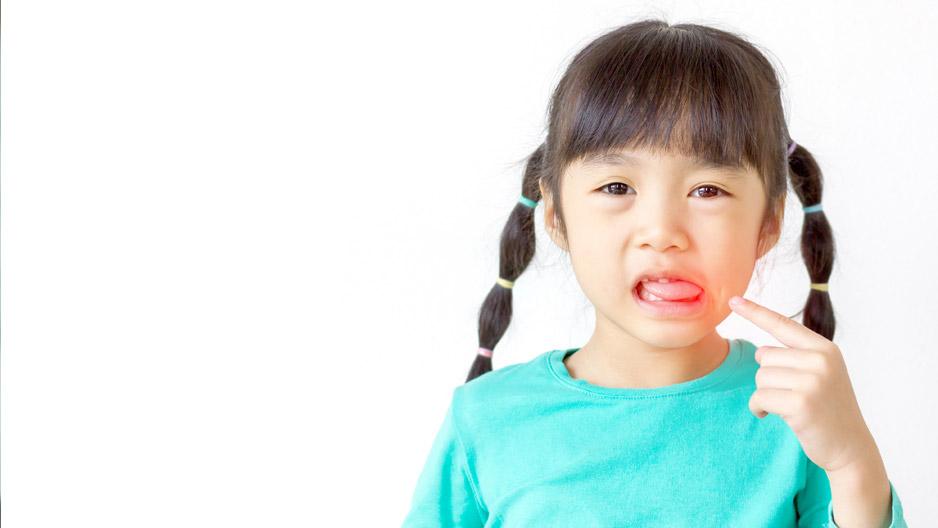 Bệnh lở miệng gây khó chịu cho trẻ thường khiến ba mẹ rất lo lắng